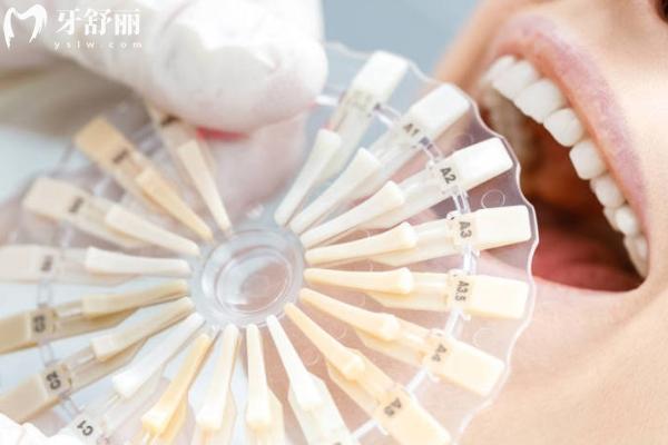 牙貼面品牌十大排名
