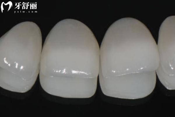 牙貼面品牌十大排名