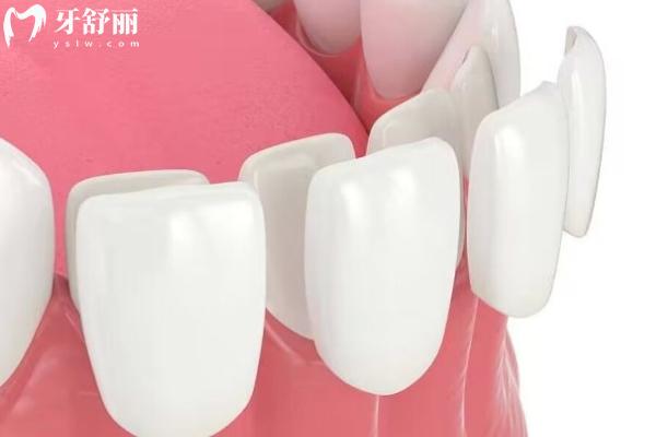 牙貼面品牌十大排名