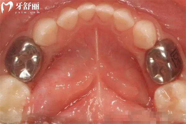 太原哪家口腔做牙冠好?分享太原牙冠修復口腔醫(yī)院排名前十及價格表