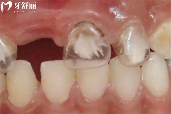 太原哪家口腔做牙冠好?分享太原牙冠修復口腔醫(yī)院排名前十及價格表