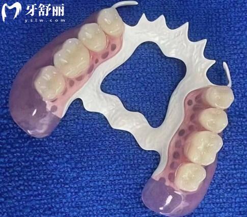 hpp活動義齒