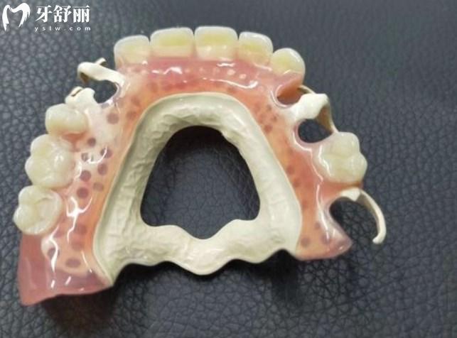 peek義齒