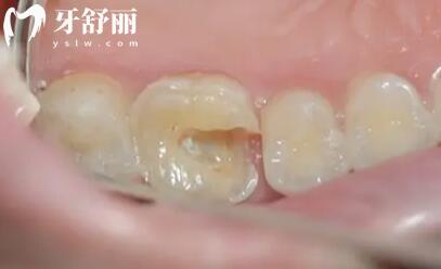 補(bǔ)牙中墊底和蓋髓是一樣的嗎?二者區(qū)別分享給你