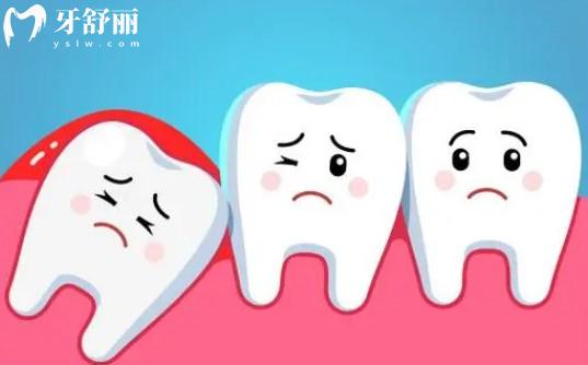 牙醫(yī)告知哪些智齒需要拔除