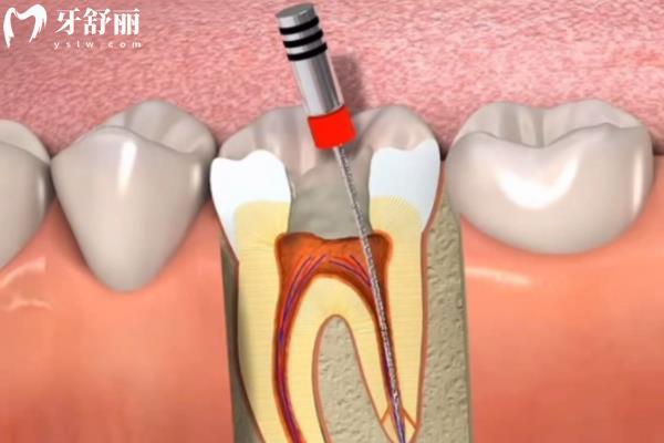 為什么根管治療完牙還會(huì)疼