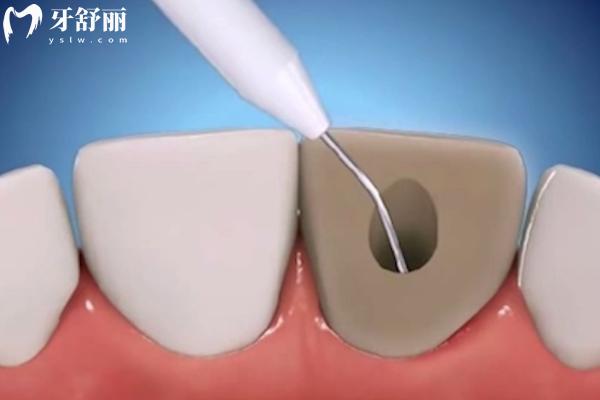 為什么根管治療完牙還會(huì)疼