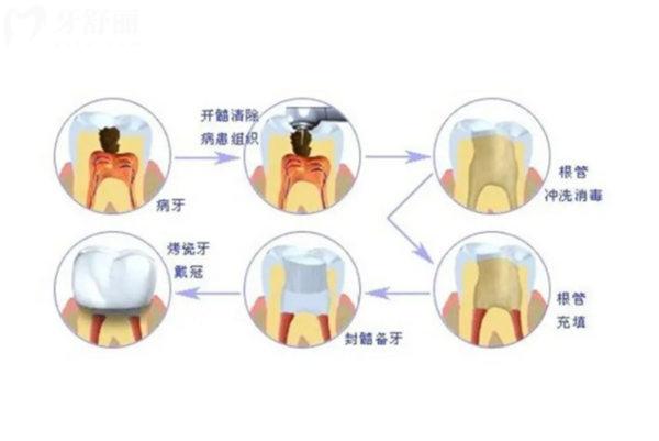根管治療的步驟