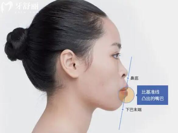 牙齒矯正臉型會(huì)改變嗎？這幾種人群矯正后臉型會(huì)有明顯變化