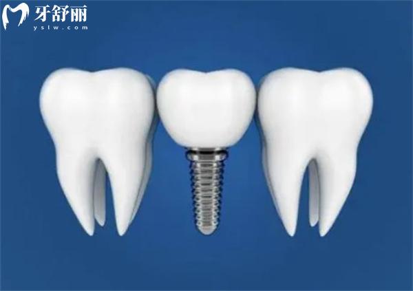 為什么植骨需要額外付費(fèi)