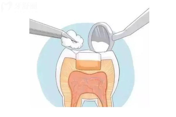 牙壞到哪種程度需要補牙？另附補牙材料與區(qū)別哦