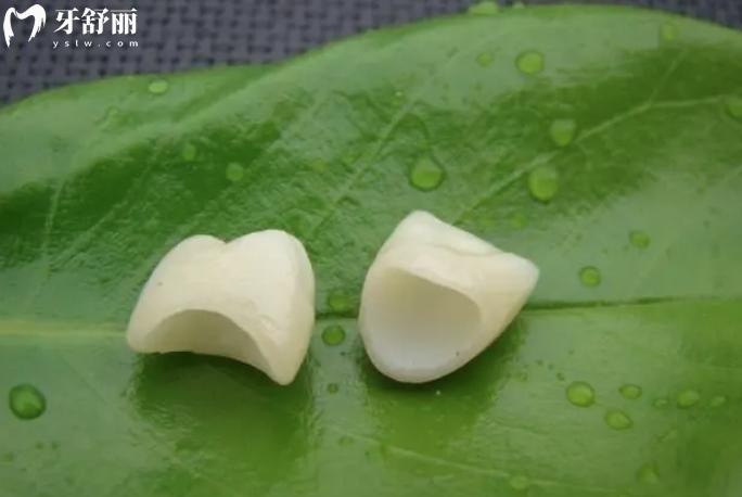 牙冠和嵌體哪個(gè)實(shí)用性強(qiáng)