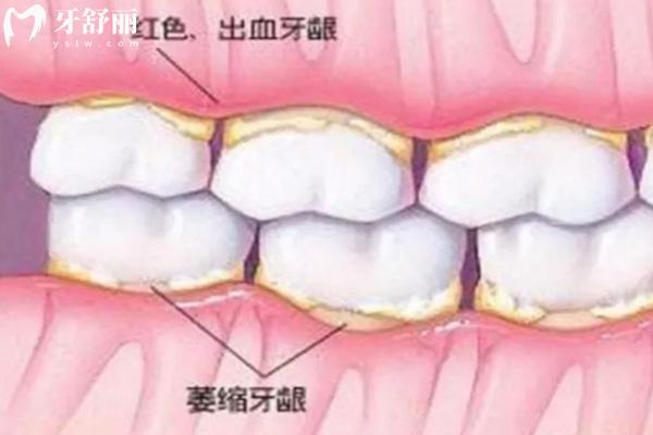 種植牙會(huì)造成牙齦萎縮嗎