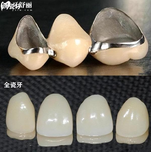 全瓷冠和烤瓷冠材質(zhì)對(duì)比