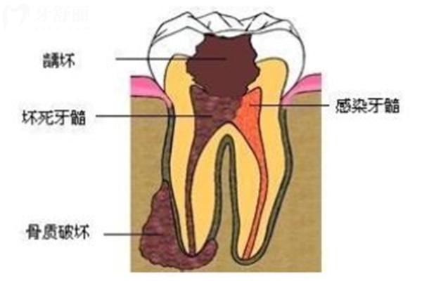沒有蛀牙但是一咬東西就疼
