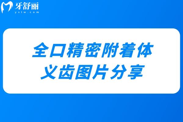 全口精密附著體義齒圖片分享