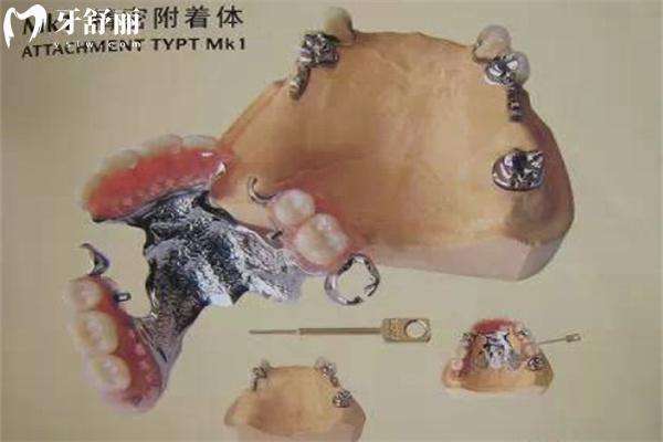 全口精密附著體義齒圖片分享:佩戴舒適可摘卸種類(lèi)齊全附價(jià)格表