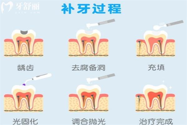 補(bǔ)牙過程
