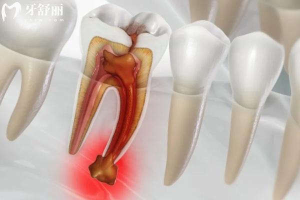 根尖周炎能自愈嗎