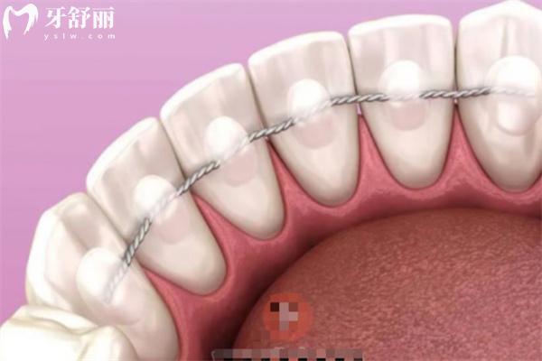 舌側(cè)絲保持器