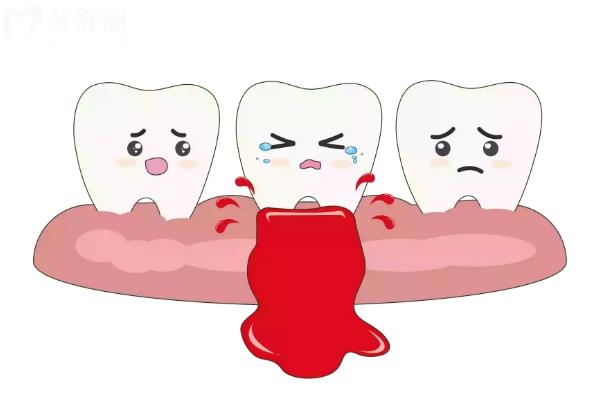 老人有牙周病還能鑲牙嗎？要看組織破壞程度，穩(wěn)定后就可以