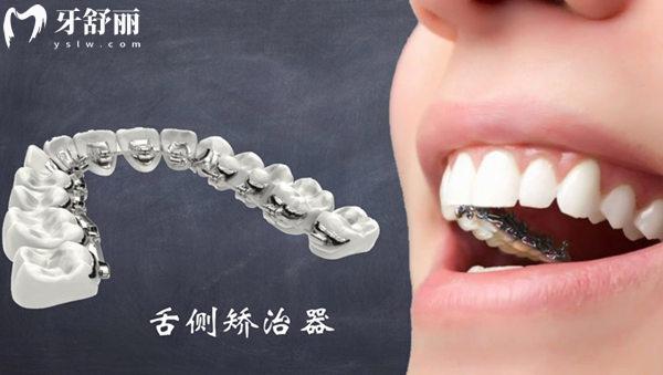 舌側(cè)矯正的優(yōu)缺點(diǎn)