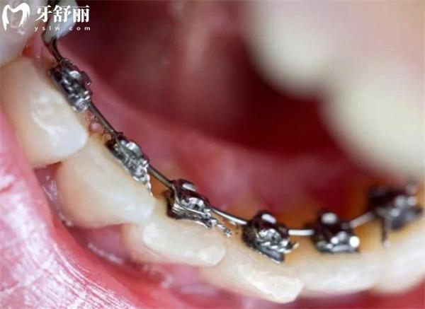 舌側(cè)矯正的適應(yīng)癥