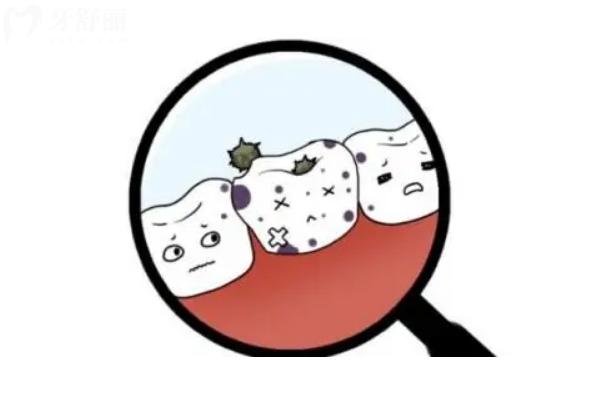 矯正期間如何控制牙菌斑？清潔到位 正確刷牙等 教你如何應對牙菌斑