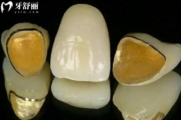 烤瓷牙套里的牙會爛嗎？