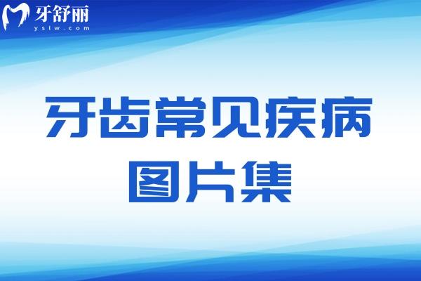 牙齒常見疾病圖片集:來了解下預防和治療方法有哪些吧