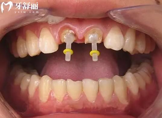 牙齒打樁的材料有哪些