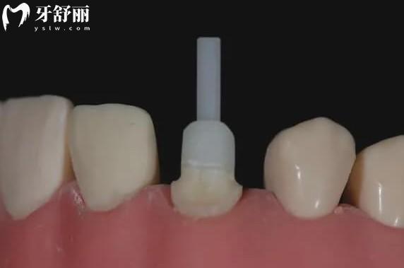 瓷樁的優(yōu)缺點(diǎn)及價(jià)格