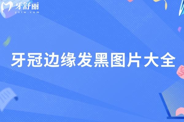 牙冠邊緣發(fā)黑圖片大全
