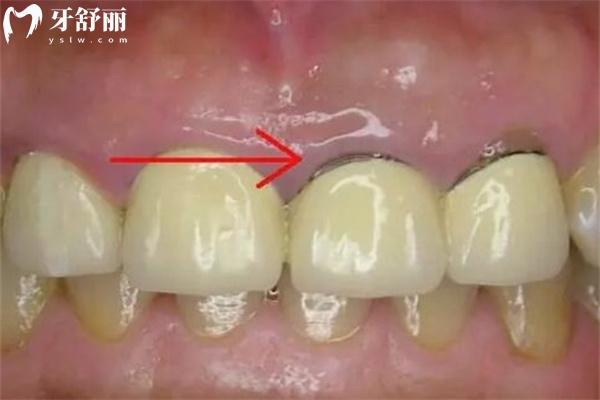 牙冠邊緣發(fā)黑圖片