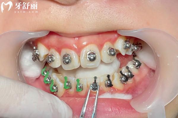 矯正牙齒結(jié)束后怎么去掉矯正器