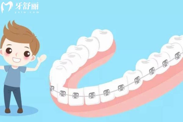 阜陽牙齒矯正多少錢