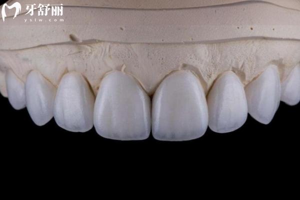 牙貼面做8顆還是16顆更好
