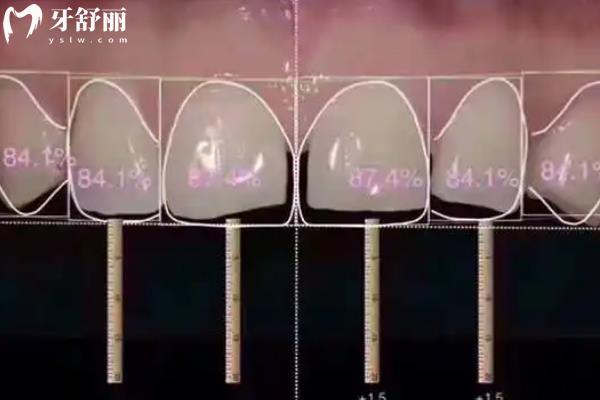 牙貼面做8顆還是16顆更好