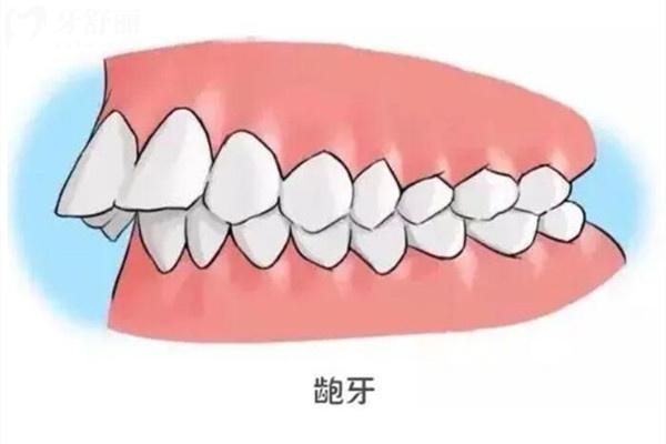 齙牙嘴巴突出矯正