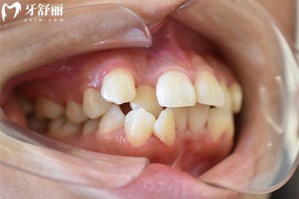 前牙突出要拔掉嗎