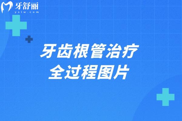 牙齒根管治療全過程圖片