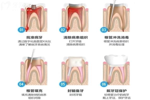 牙齒根管治療全過程圖片