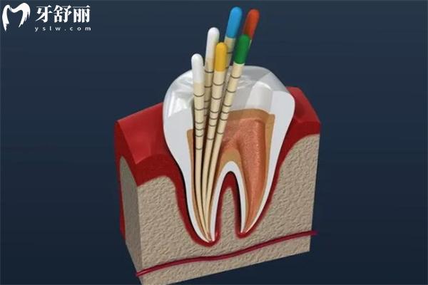 牙齒根管治療全過程圖片