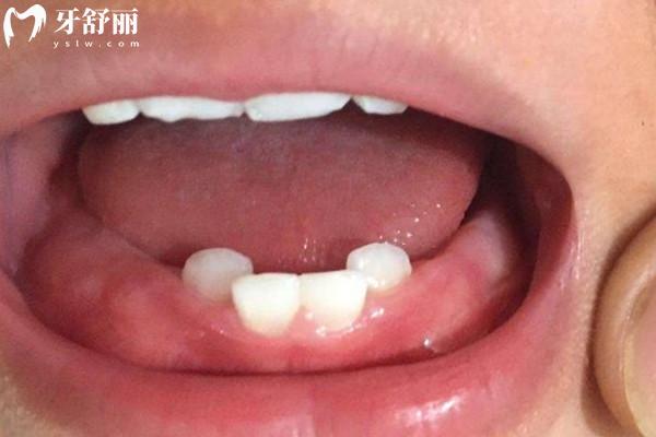 乳牙不整齊會(huì)影響恒牙嗎