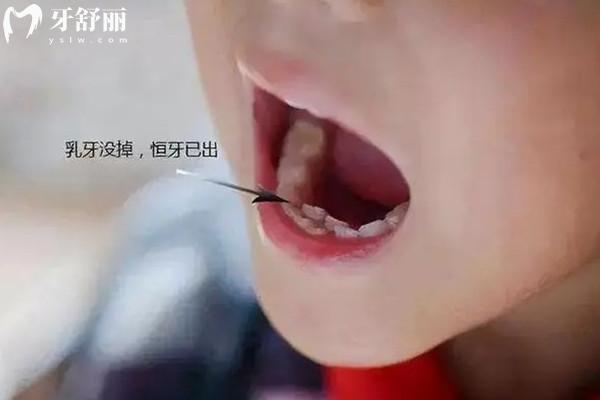 乳牙不整齊會(huì)影響恒牙嗎
