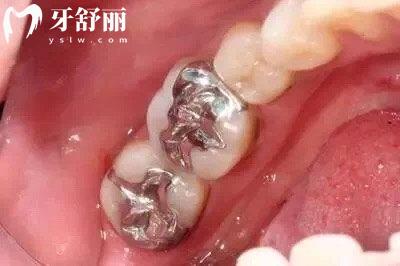 嵌體有哪些材質(zhì)？哪種比較好？