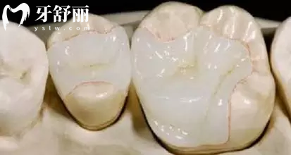嵌體有哪些材質(zhì)？哪種比較好？