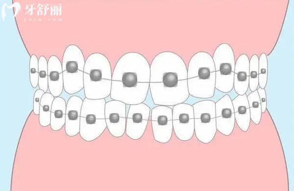 西寧牙齒矯正多少錢(qián)