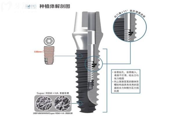 韓國(guó)禎諾zenois種植牙