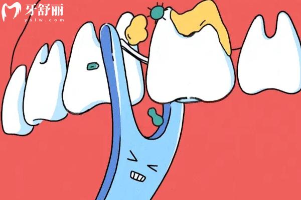 為什么對牙簽說NO？會引發(fā)牙周疾病/牙齦發(fā)炎/牙齒敏感等